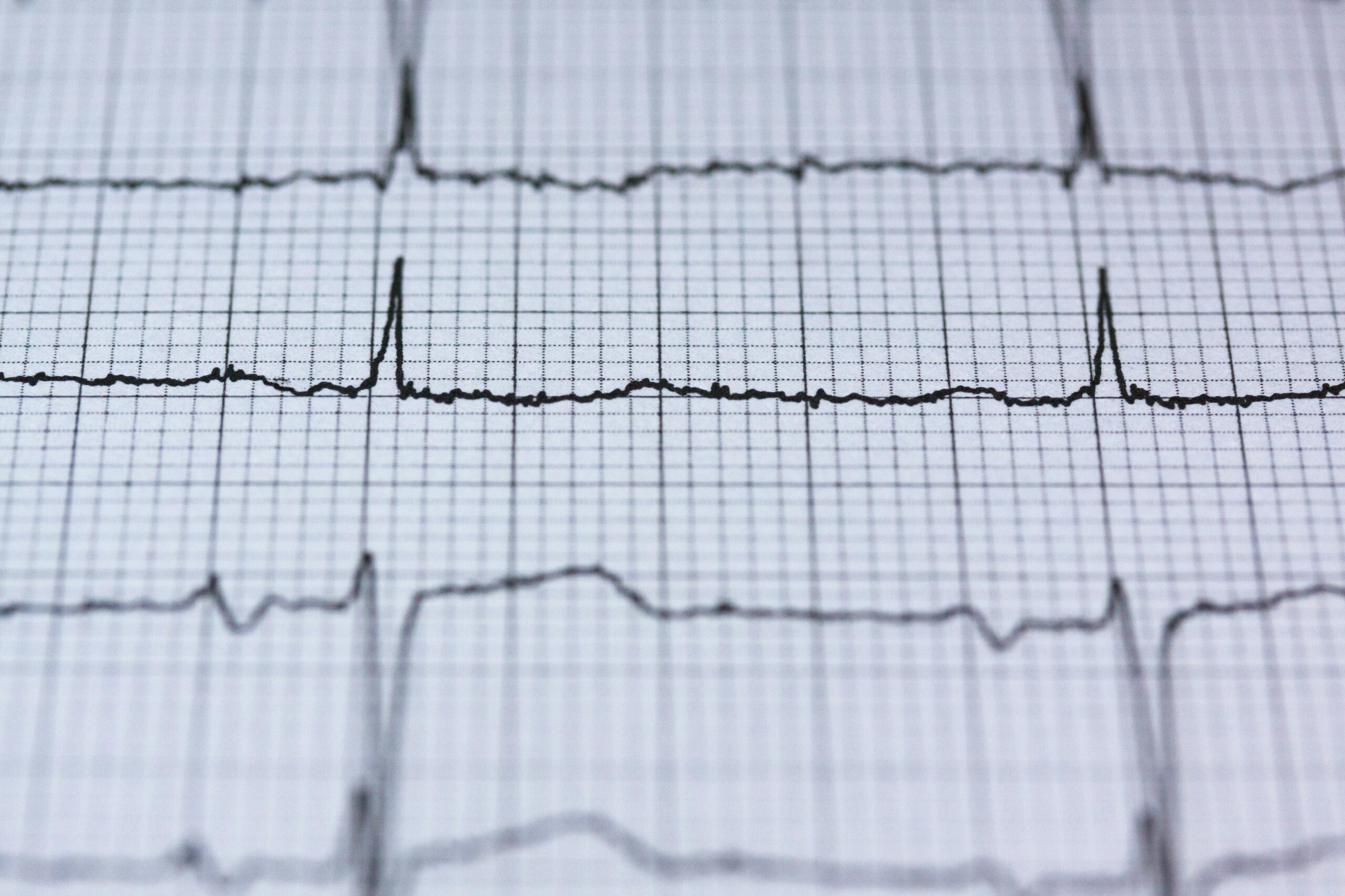 Close-up of an electrocardiogram (ECG) strip showing a heart rhythm, representing diagnostic treatments and procedures in cardiology at LSDC Healthcare London.